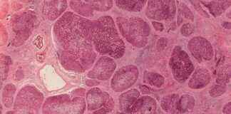 Bariatric Surgery Halts Liver Disease Progression in Obese Patients – Study bariatric-surgery-halts-liver-disease-progression-in-obese-patients-study