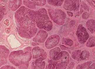 Bariatric Surgery Halts Liver Disease Progression in Obese Patients – Study bariatric-surgery-halts-liver-disease-progression-in-obese-patients-study