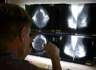 Protein Degrader in Breast Cancer Trial: Mixed Results protein-degrader-in-breast-cancer-trial-mixed-results